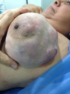 Tumores benignos (tumor Phyllodes)